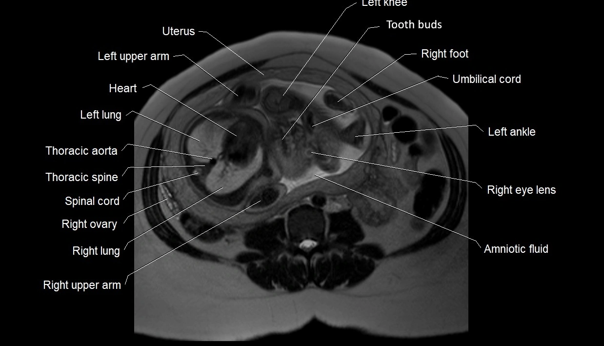 MRI fetal anatomy axial image 14.webp